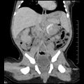 Neonatal neuroblastoma (Radiopaedia 56651-63438 Coronal non-contrast 29).jpg