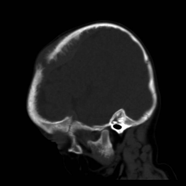 File:Neuroblastoma with skull metastases (Radiopaedia 30326-30958 Sagittal bone window 9).jpg