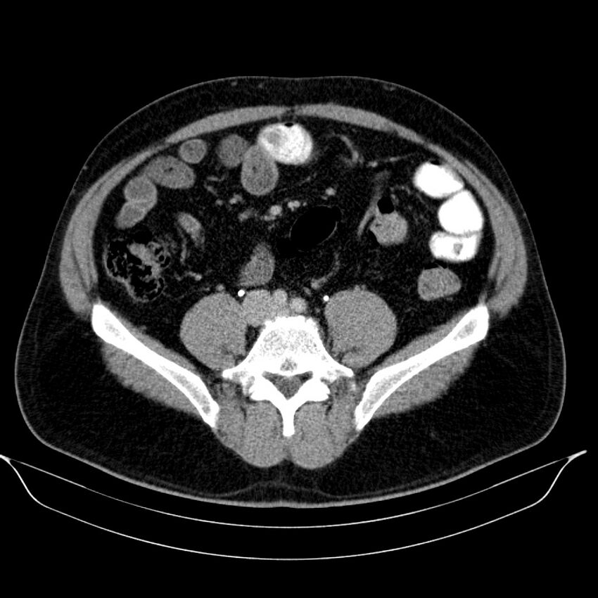 Neuroendocrine tumor of head of pancreas (Radiopaedia 57538-64502 D 56).jpg
