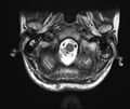 Neurofibromatosis type 1 (Radiopaedia 80355-93740 Axial T2 1).jpg