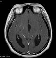 Neurofibromatosis type 2 - cranial and spinal involvement (Radiopaedia 5351-7111 Axial T1 C+ 11).jpg