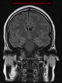 Neuroglial cyst (Radiopaedia 10713-11184 Coronal FLAIR 14).jpg