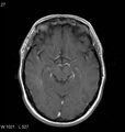 Neurosarcoidosis (Radiopaedia 10930-11351 Axial T1 C+ 8).jpg