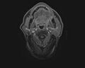 Non-Hodgkin lymphoma - parotid gland (Radiopaedia 71531-81890 E 10).jpg