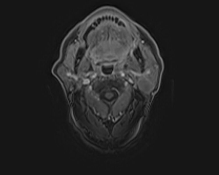 File:Non-Hodgkin lymphoma - parotid gland (Radiopaedia 71531-81890 E 10).jpg