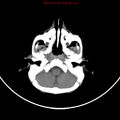 Non-accidental injury - bilateral subdural with acute blood (Radiopaedia 10236-10765 Axial non-contrast 3).jpg