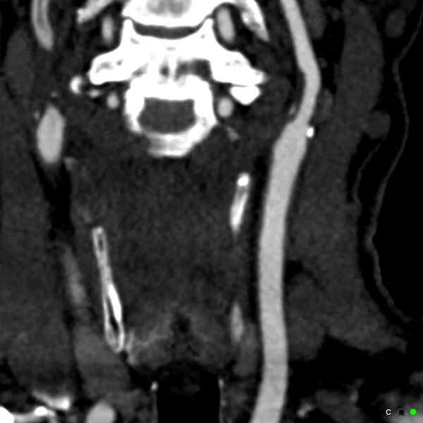 File:Non-occlusive intraluminal internal carotid artery thrombus (Radiopaedia 37751-39658 C 72).jpg
