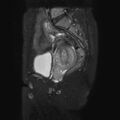 Non-puerperal uterine inversion (Radiopaedia 78343-90983 Sagittal T2 fat sat 10).jpg