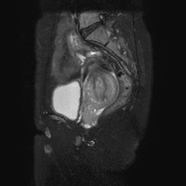 File:Non-puerperal uterine inversion (Radiopaedia 78343-90983 Sagittal T2 fat sat 10).jpg