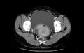 Non-puerperal uterine inversion (Radiopaedia 78343-91094 A 46).jpg