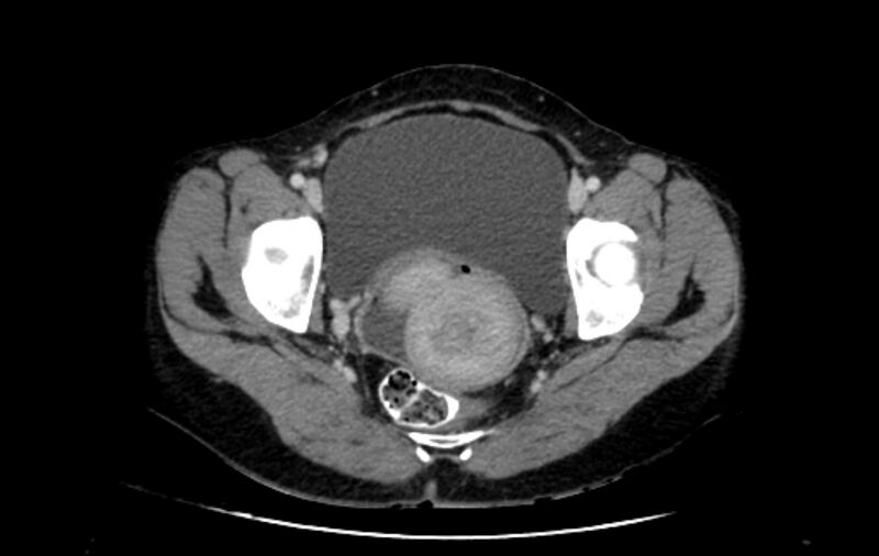 File:Non-puerperal uterine inversion (Radiopaedia 78343-91094 A 46).jpg