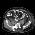 Non Hodgkin lymphoma in a patient with ankylosing spondylitis (Radiopaedia 84323-99621 Axial non-contrast 48).jpg
