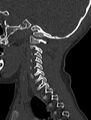 Normal CT cervical spine - pediatric (Radiopaedia 52549-58462 Sagittal bone window 42).jpg