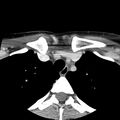 Normal CT of the neck (Radiopaedia 14575-14500 Axial C+ 71).jpg