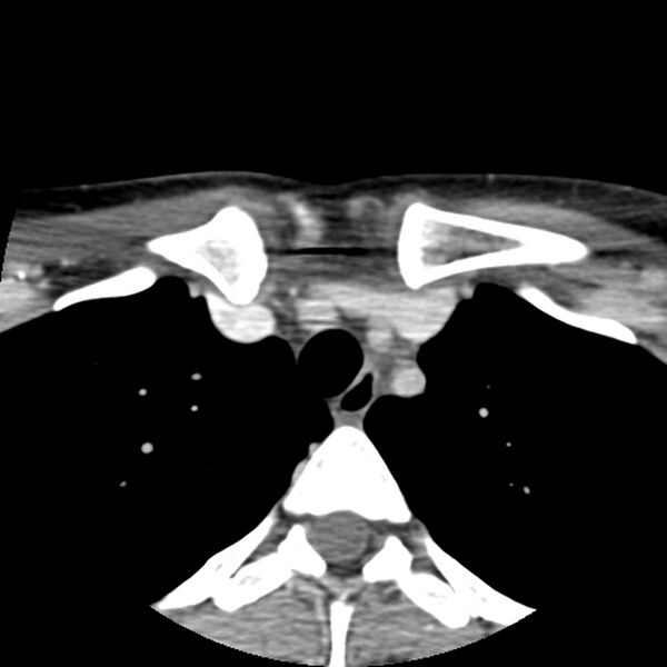 File:Normal CT of the neck (Radiopaedia 14575-14500 Axial C+ 71).jpg