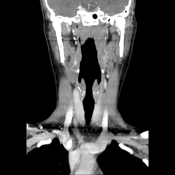 File:Normal CT of the neck (Radiopaedia 14575-14500 Coronal C+ 26).jpg