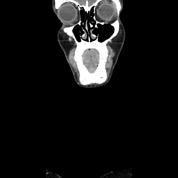 File:Normal CT of the neck (Radiopaedia 14575-14500 Coronal C+ 6).jpg