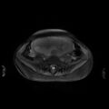 Normal MRI abdomen in pregnancy (Radiopaedia 88001-104541 D 38).jpg