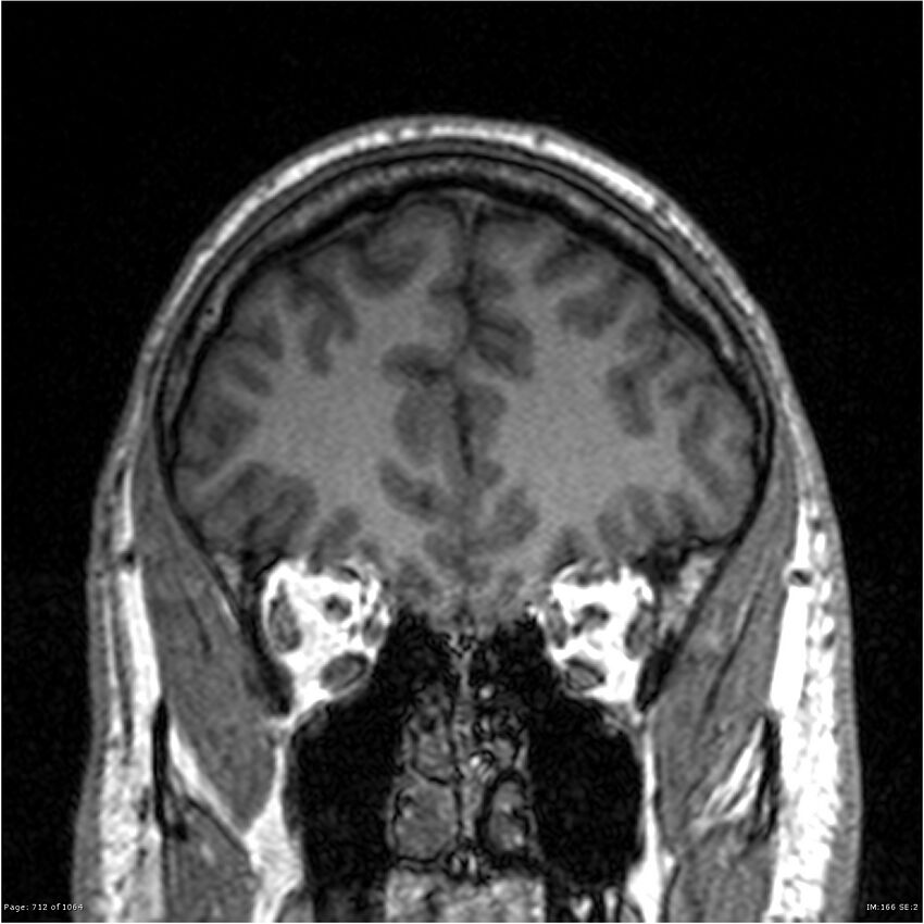 Normal brain MRI (non-focal epilepsy protocol) (Radiopaedia 38571-40700 Coronal T1 82).jpg