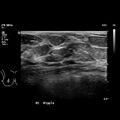 Normal breast mammography (tomosynthesis) and ultrasound (Radiopaedia 65325-74354 Right breast 14).jpeg