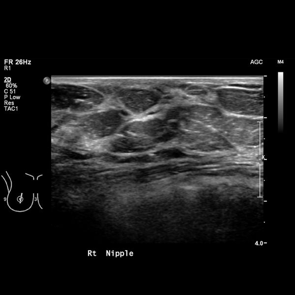 File:Normal breast mammography (tomosynthesis) and ultrasound (Radiopaedia 65325-74354 Right breast 14).jpeg