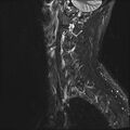 Normal cervical spine MRI (Radiopaedia 38418-40496 Sagittal STIR 1).jpg