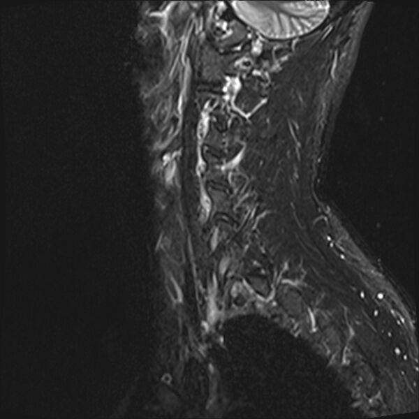 File:Normal cervical spine MRI (Radiopaedia 38418-40496 Sagittal STIR 1).jpg