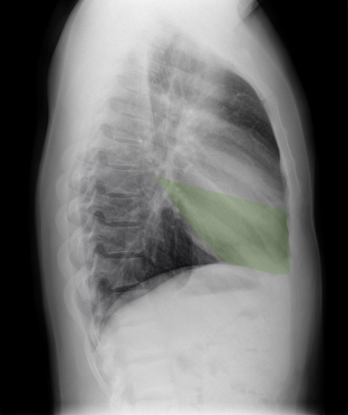 File:Normal chest x-ray - lobes (illustration) (Radiopaedia 58938-66192 J 1).png