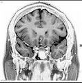 Normal coronal brain (Radiopaedia 6676-7910 B 14).jpg