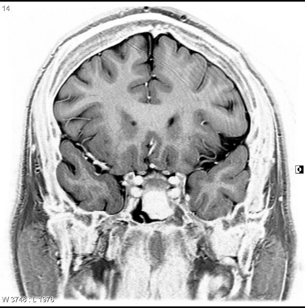 File:Normal coronal brain (Radiopaedia 6676-7910 B 14).jpg