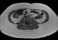 Normal liver MRI with Gadolinium (Radiopaedia 58913-66163 Axial T1 in-phase 2).jpg