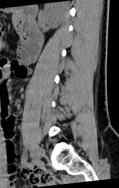 File:Normal lumbar spine CT (Radiopaedia 46533-50986 C 74).png