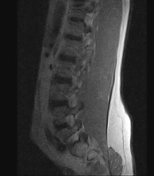 File:Normal lumbar spine MRI - low-field MRI scanner (Radiopaedia 40976-43699 Sagittal T1 10).jpg