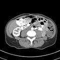 Normal multiphase CT liver (Radiopaedia 38026-39996 B 51).jpg