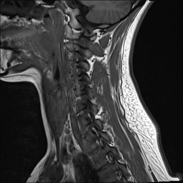 File:Normal trauma cervical spine MRI (Radiopaedia 32130-33071 Sagittal T1 12).jpg