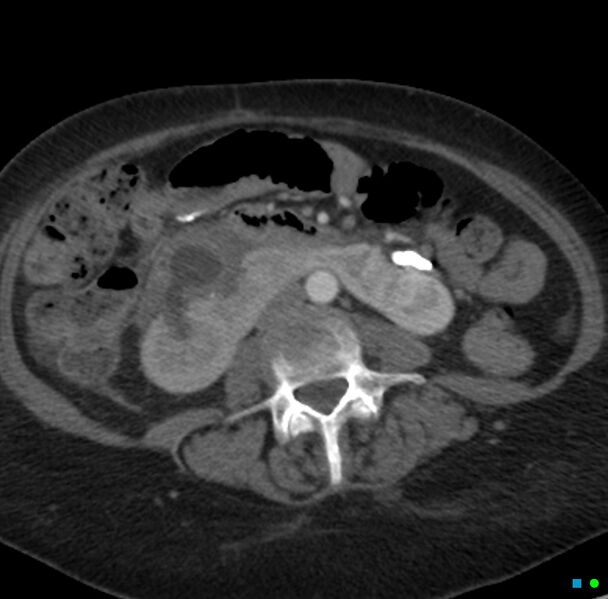 File:Obstructed infected horseshoe kidney (Radiopaedia 18116-17898 B 17).jpg