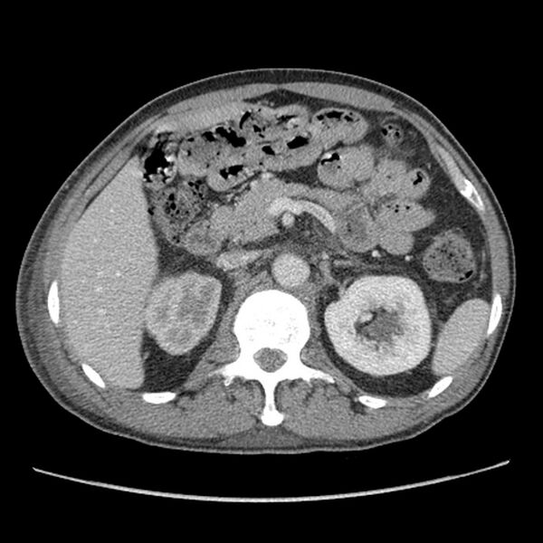 File:Obstructive bladder transitional cell carcinoma (Radiopaedia 9825-10410 A 7).jpg