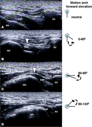Dynamic musculoskeletal sonography of individual with shoulder impingement syndrome after receiving hook plate fixation of left distal clavicle fracture