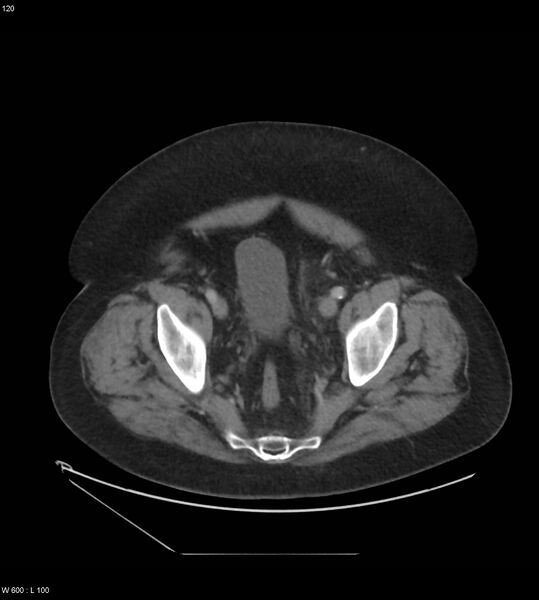 File:Abdominal aortic aneurysm with intramural hematoma then rupture (Radiopaedia 50278-55631 Axial C+ arterial phase 111).jpg
