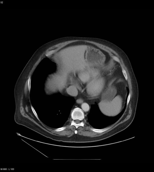 File:Abdominal aortic aneurysm with intramural hematoma then rupture (Radiopaedia 50278-55631 Axial C+ arterial phase 43).jpg