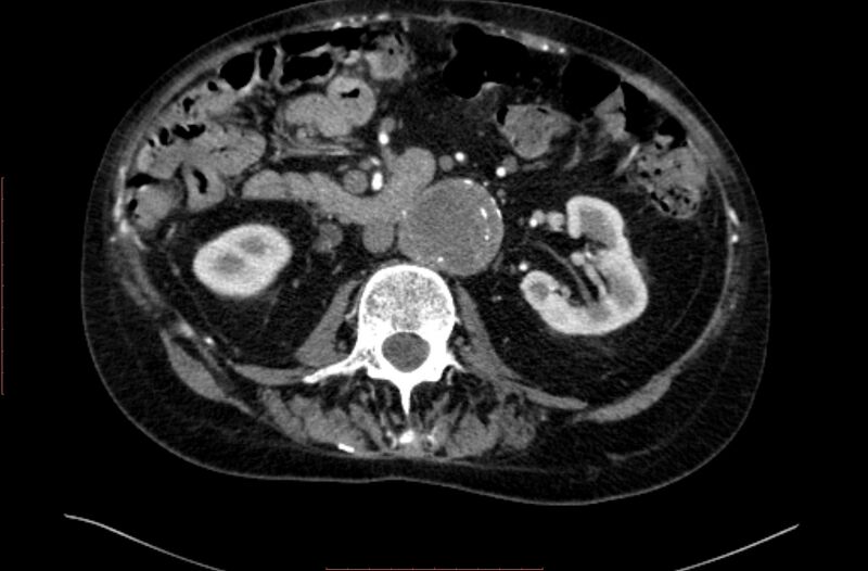 File:Abdominal aortic interposition tube graft and aneurysm thrombosis (Radiopaedia 71438-81857 Axial C+ arterial phase 71).jpg