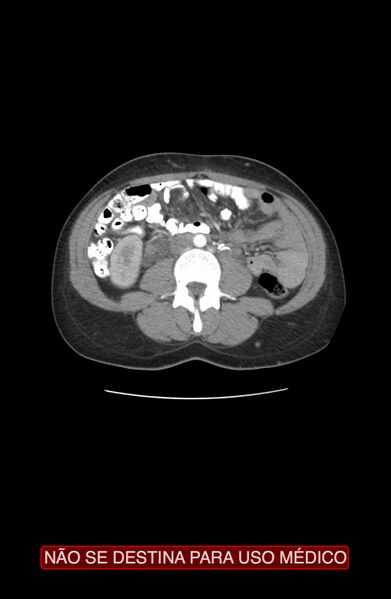 File:Abdominal desmoid tumor (Radiopaedia 44024-47540 Axial C+ arterial phase 16).jpg