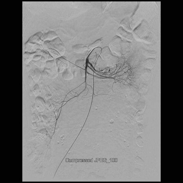 File:Abernethy malformation (Radiopaedia 42006-45462 Frontal Superior mesenteric artery 4).jpg