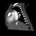 Aberrant left pulmonary artery (pulmonary sling) (Radiopaedia 42323-45435 Sagittal C+ arterial phase 19).jpg
