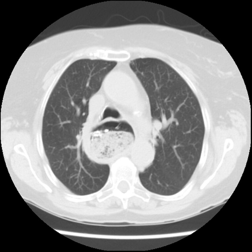 Achalasia (Radiopaedia 44094-47649 Axial lung window 21).jpg