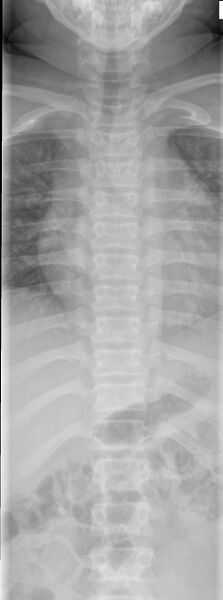 File:Achondroplasia (Radiopaedia 9294-9979 D 5).jpg