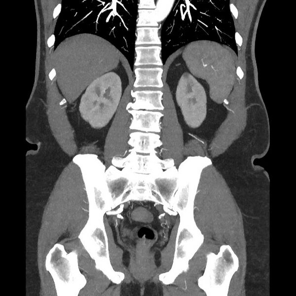 File:Active colonic bleed on CT (Radiopaedia 49765-55025 Coronal art MIP 44).jpg