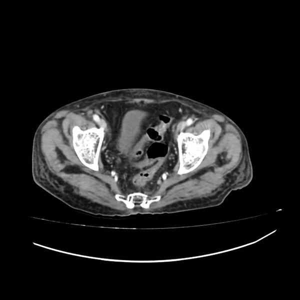 File:Acute-on-chronic Crohn disease with enteroenteric fistula (Radiopaedia 66686-75987 B 72).jpg