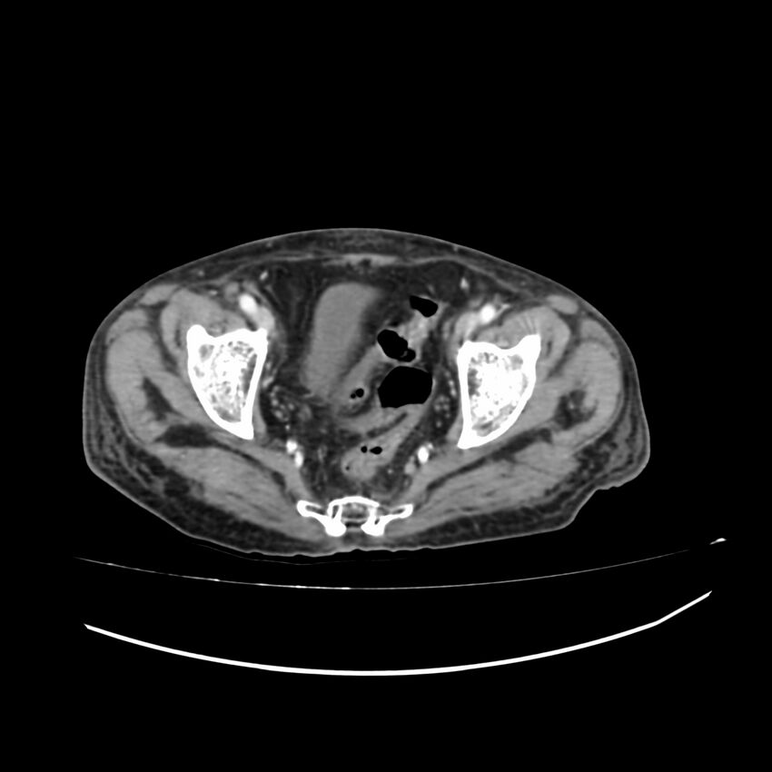 Acute-on-chronic Crohn disease with enteroenteric fistula (Radiopaedia 66686-75987 B 72).jpg