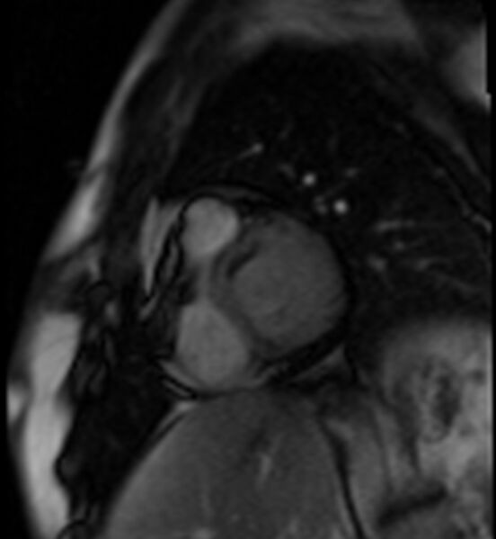 File:Acute anteroseptal myocardial infarction (Radiopaedia 68409-77945 Short axis (basal) Perfusion 19).jpg